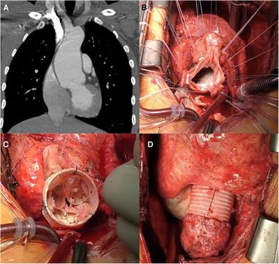 Redo aortic root surgery post-Ross procedure